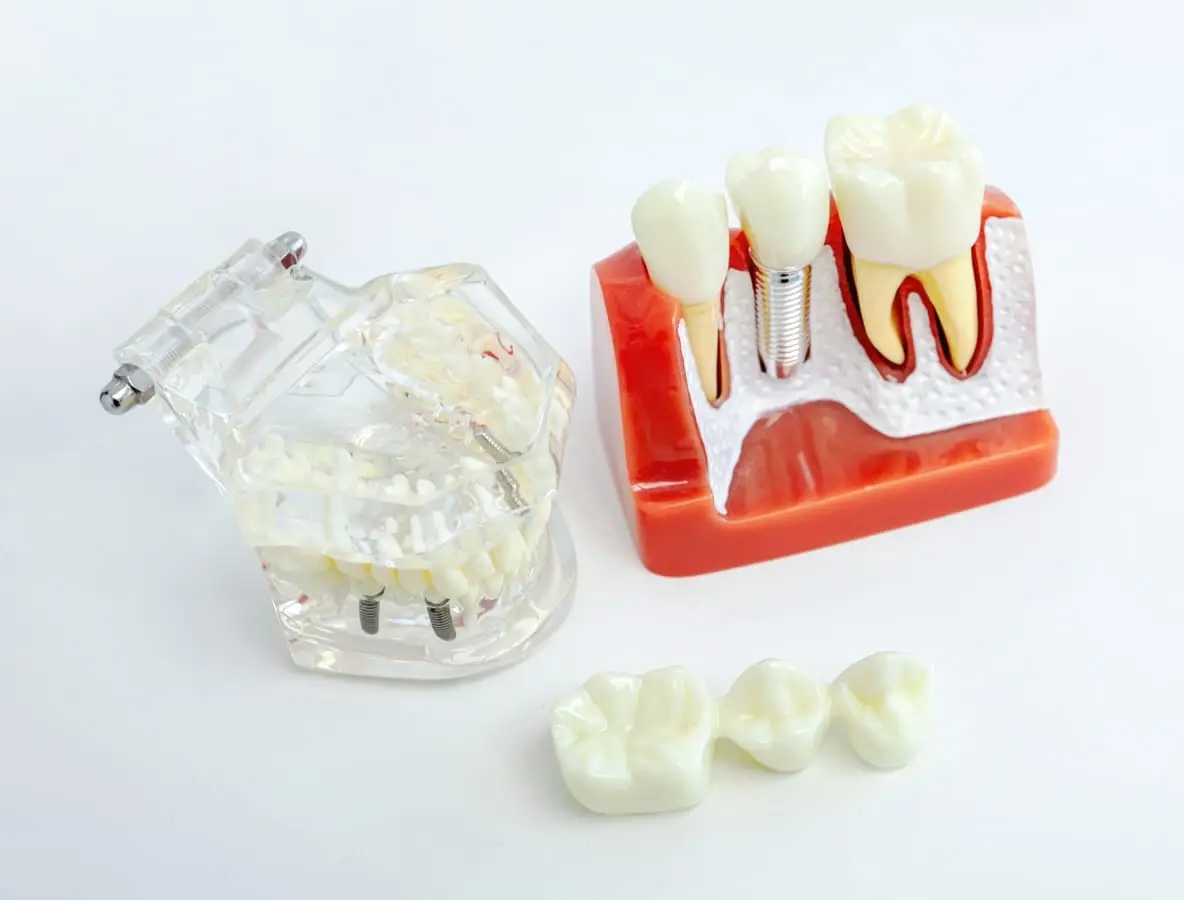 Dental Implants in